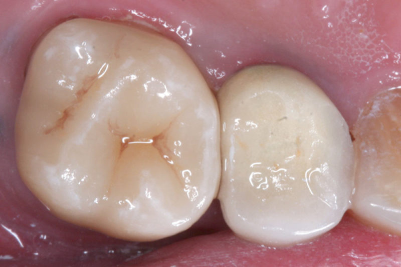 single posterior crown after