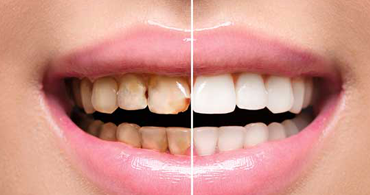 Before & After Tooth Restoration
