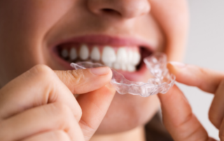 clear aligner therapy