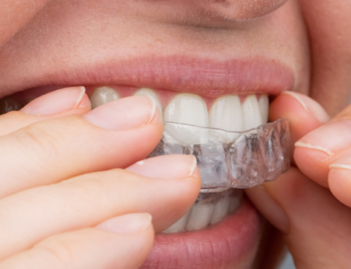 The Path to a Perfect Smile: Comparing Teeth Alignment Options